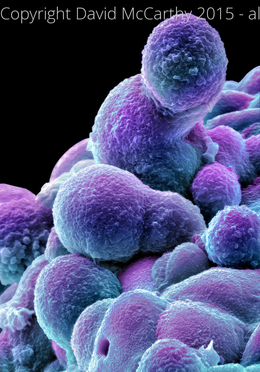 Human Prostate Carcinoma cells